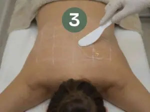 Applying cooling gel laser hair removal