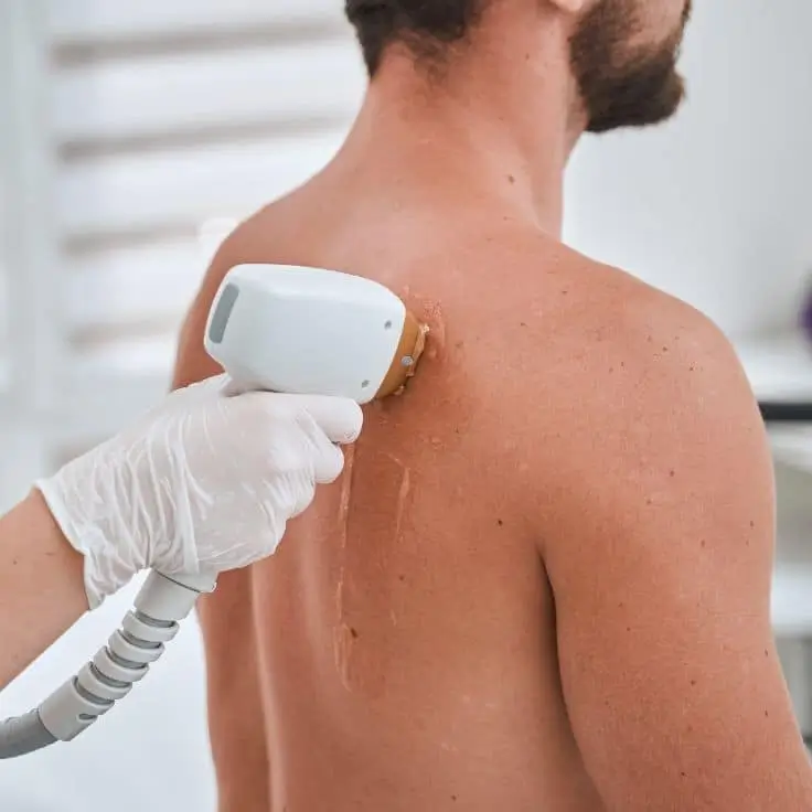 back laser hair removal in delhi