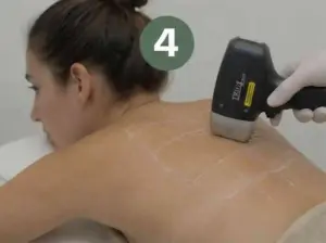 Applying laser hair removal shots