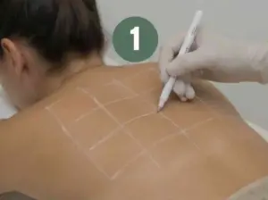 Marking the area laser hair removal